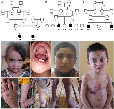 Whole Exome Sequencing Confirms Molecular Diagnostics of Three <mark class="highlighted">Pakhtun</mark> Families With Autosomal Recessive Epidermolysis Bullosa